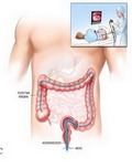 Цифровая эндоскопия: Видеоколоноскопия (ВКС)